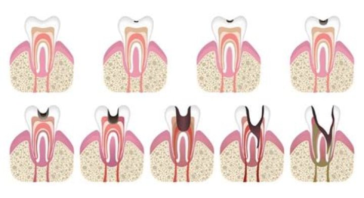 Can a cavity go away on its own?