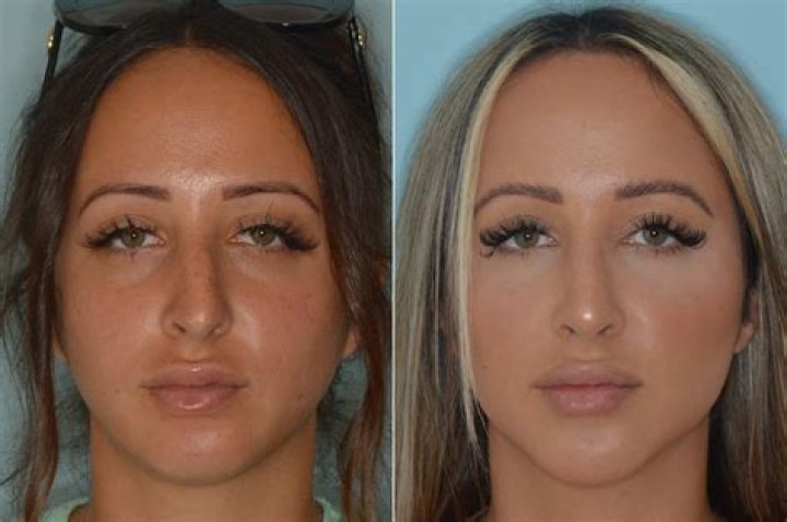Can blowing nose ruin rhinoplasty?
