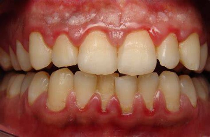 Can gingivitis be one spot?