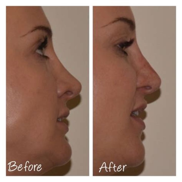 Can I reshape my nose without surgery?