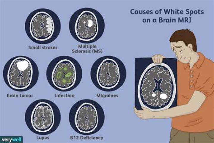 Can migraines cause white spots on brain MRI?