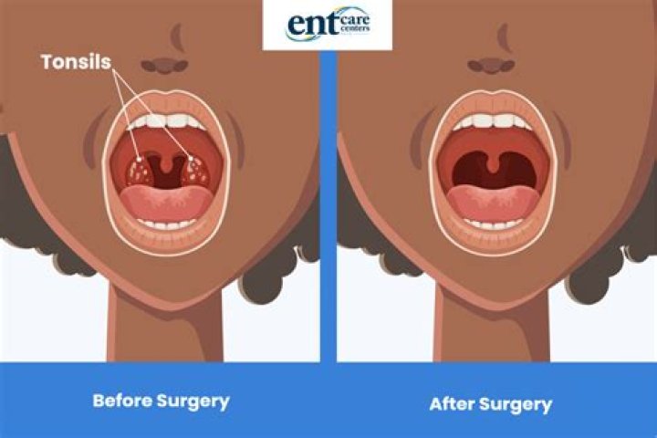Can removing tonsils help with ear pain?
