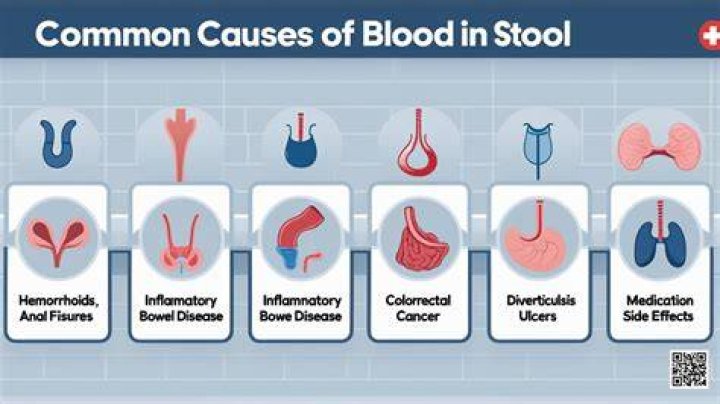 Can silent reflux cause blood in stool?