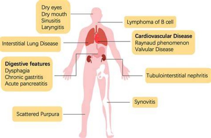 Can Sjogren's affect the heart?