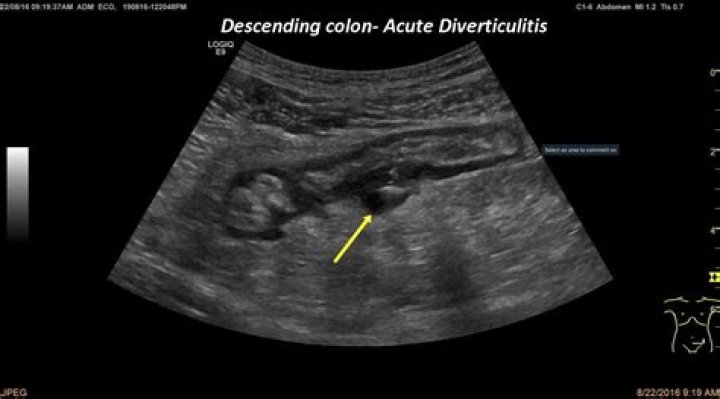 Can you see diverticulitis on ultrasound?