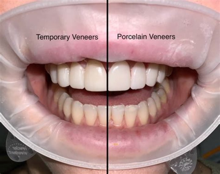 Do temporary veneers look like permanent?