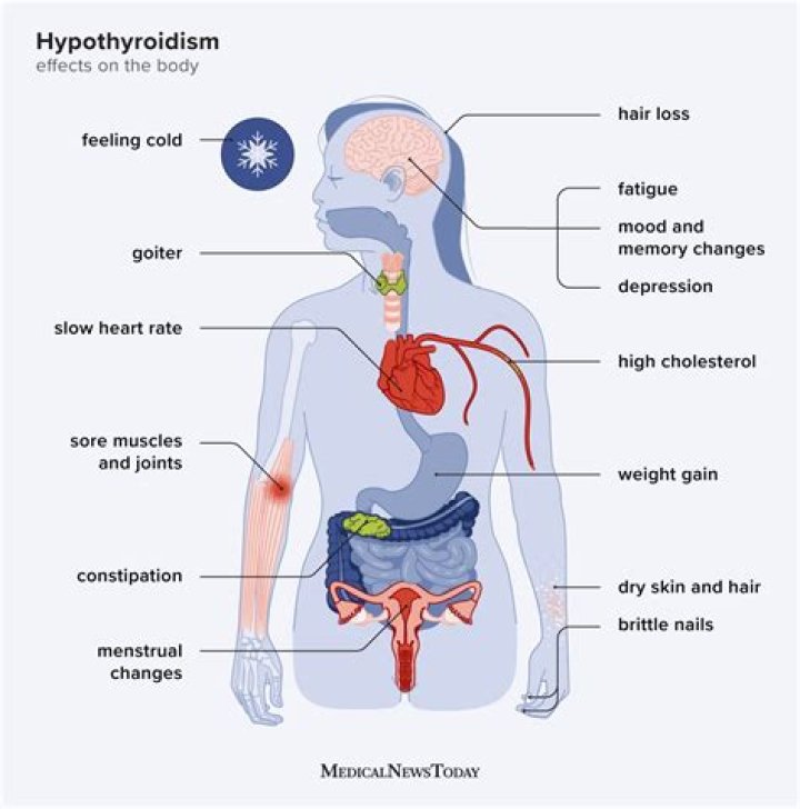 Does hypothyroidism cause ringing in the ears?