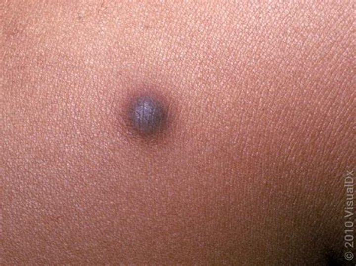 How do you prevent dermatofibroma?