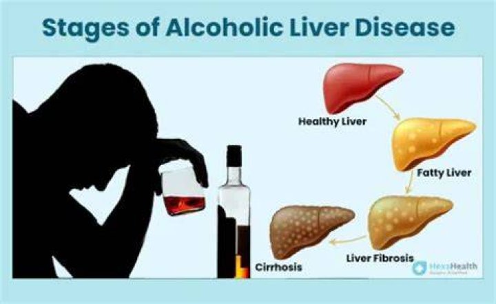 How long can you live with cirrhosis of the liver from alcohol?