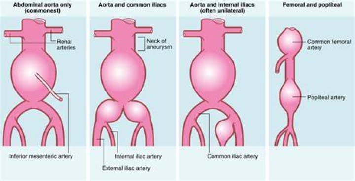 How long do brain aneurysms take to form?