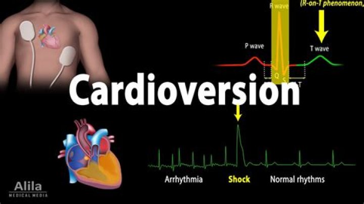 How many times can you have a cardioversion?