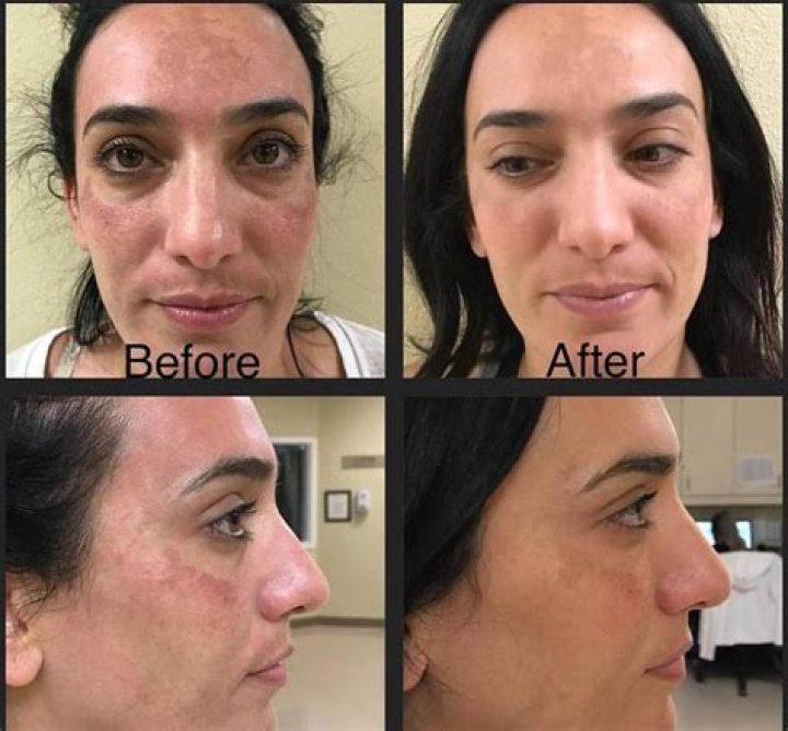 Is Dermarolling and microneedling the same?