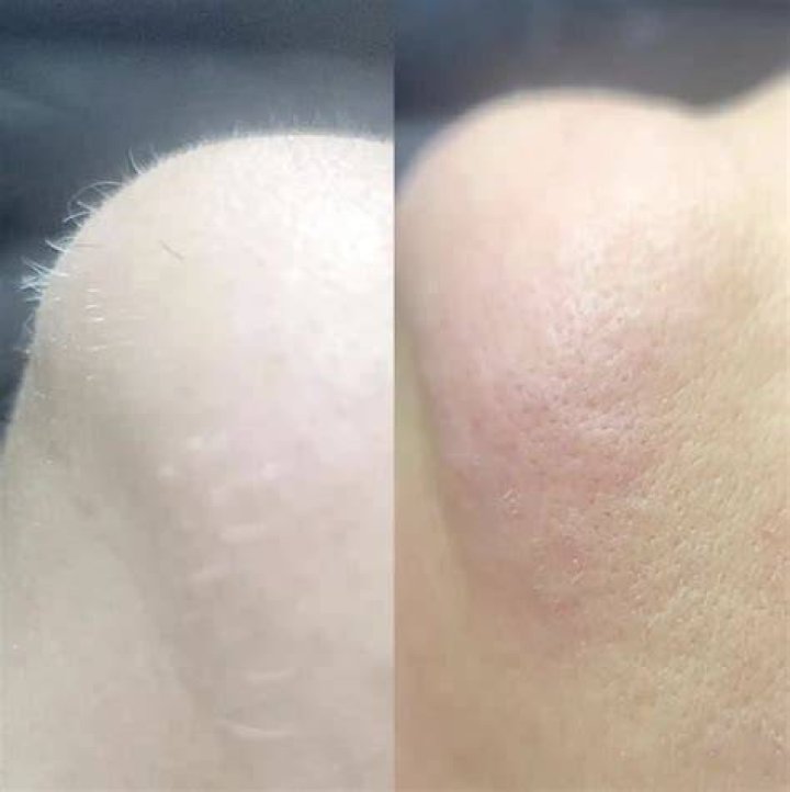 Is laser hair removal cancerous?