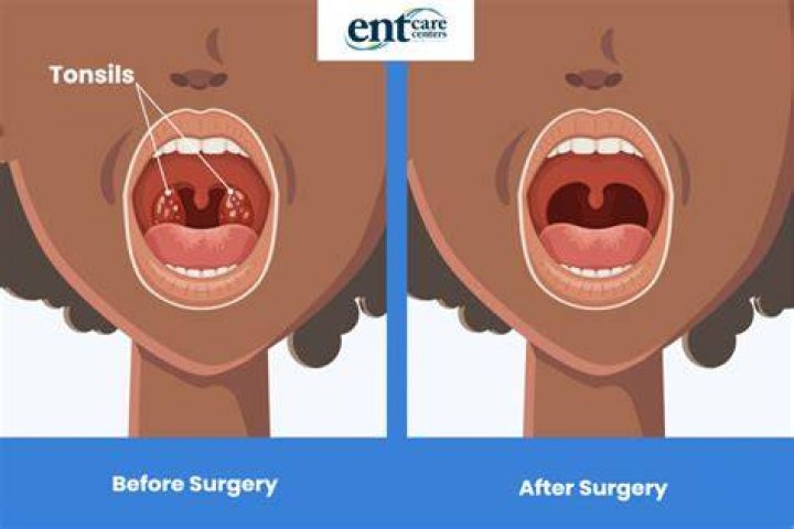 What are the pros of getting your tonsils removed?