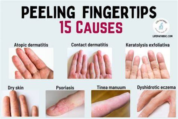 What causes fingers to turn black?