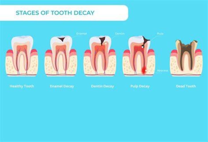 What causes root decay in teeth?
