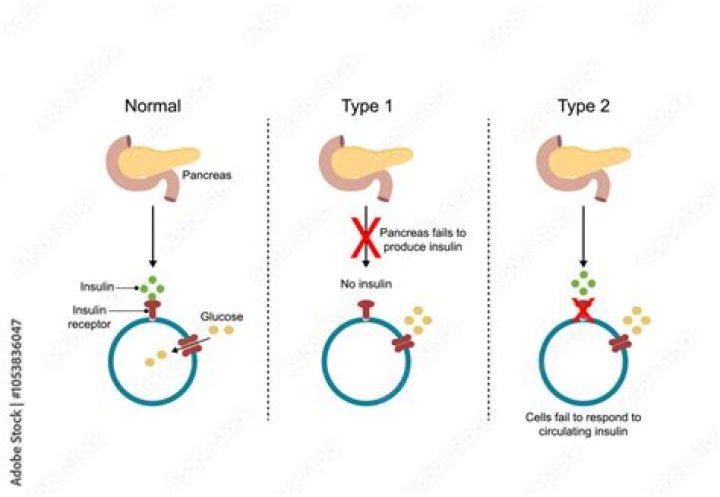 What causes the pancreas to stop producing insulin?