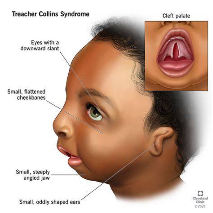 What causes Treacher Collins syndrome?