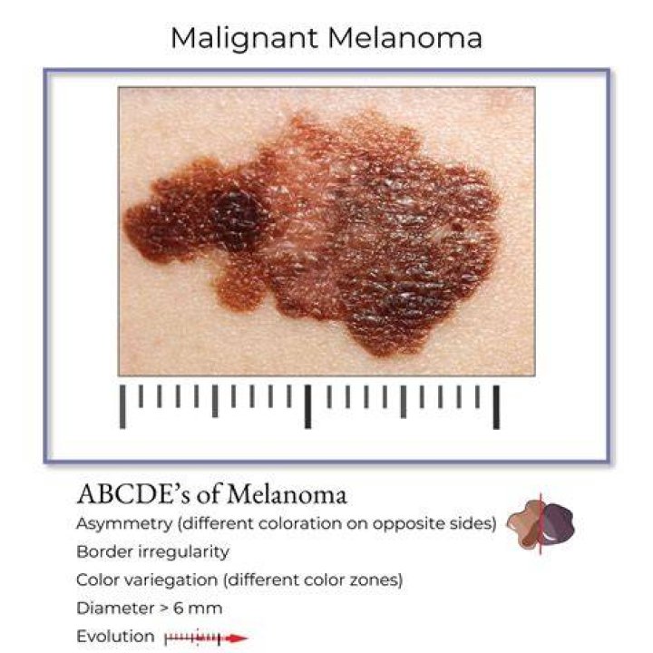 What did your melanoma look like?