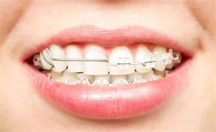 What type of braces work the fastest?