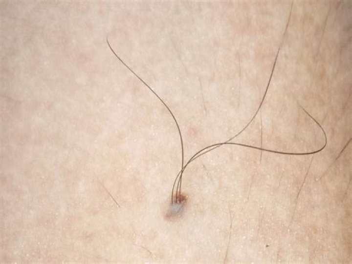 Why do I have hair on my back and I'm a girl?