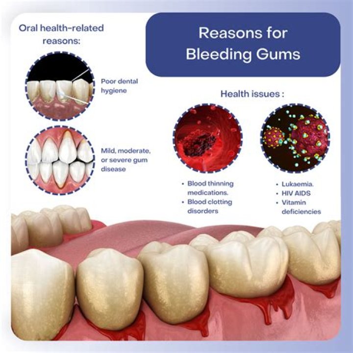 Why do my gums bleed when I get my teeth cleaned?